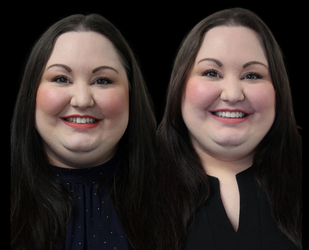 Before and after smile makeover