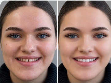 Before and after smile makeover