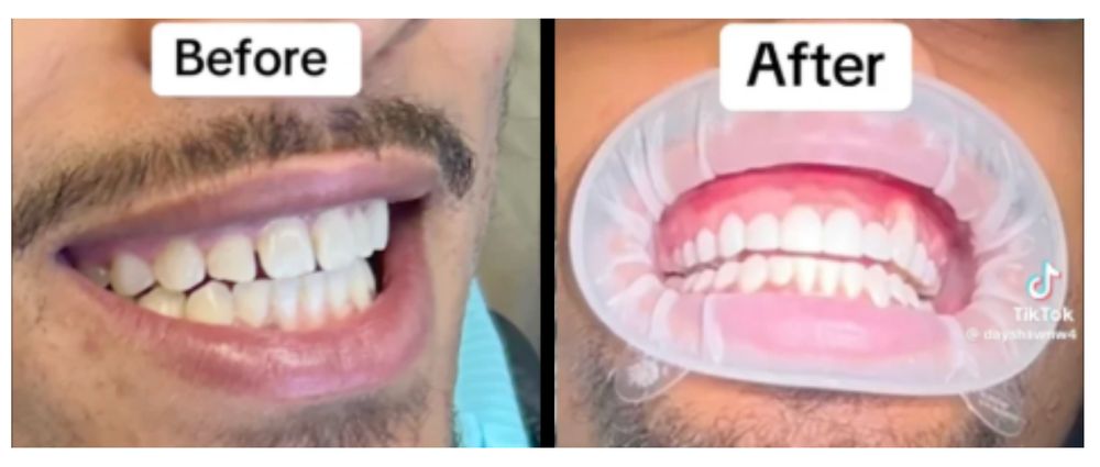 Before and after smile makeover