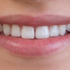 Patient smile after InstaVeneers
