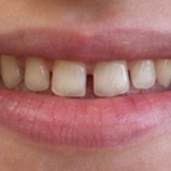 Patient smile before InstaVeneers